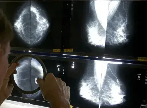 A radiologist uses a magnifying glass to check mammograms for breast cancer in Los Angeles, May 6, 2010. An influential U.S. task force now says women should get screened for breast cancer every other year starting at age 40. The U.S. Preventive Services Task Force announced the updated guidance Tuesday, April 30, 2024. (AP Photo/Damian Dovarganes, File)